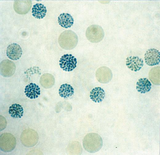 Higgs Figure 4. Typical blood findings in α thalassemia myelodysplasia syndrome (ATMDS). / A. A peripheral blood smear (May-Grünwald-Giemsa, ×400) from an untransfused patient. Many red cells are hypochromic and/or microcytic, while others appear relatively normal and well-preserved, presumably the descendants of non-thalassemic clones. / B. Classic hemoglobin H inclusions (HbH) in an ATMDS patient seen after supravital staining (Brilliant cresyl blue, ×400).
