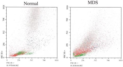 Vardiman figure 1. (in List et al). Flow cytometry forward (X axis) versus side (Y axis) light scatter histograms of normal bone marrow cells and marrow cells from a patient with RCMD. / The histogram from the patient shows that glycophorin A+ erythroid precursors (red) are larger in MDS (greater forward light scatter), corresponding to megaloblastic erythropoiesis (lymphocytes painted green as a reference). Note differences between light scatter properties of normal myeloid precursors and those of the MDS patient. / Color key: Red: glycophorin A; Blue: CD14; Green: CD45++ lymphocytes; Gray: CD45+ myeloid precursors. / Courtesy of Dr. Anna Porwit-MacDonald, Karolinska University Hospital