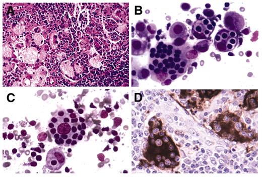Natkunam Figure 2. (in McClain et al). Sinus histiocytosis with massive lymphadenopathy involving a cervical lymph node. / A. Expanded lymph node sinuses filled with distinctive histiocytes in a background rich in plasma cells, foamy macrophages and small lymphocytes. / B. Distinctive histiocytes exhibiting emperipolesis where intact lymphocytes, some housed in vacuoles, are present within the cytoplasm. / C. Emperipolesis in a histiocyte with a prominent central nucleolus and a delicate nuclear membrane. / D. Immunohistochemical staining for the S100 protein highlights histiocytes with emperipolesis.