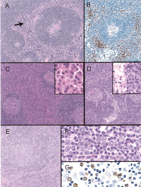 Swerdlow Figure 4. (in McClain et al). Histopathology and selected immunophenotypic features of major subtypes of Castleman disease. / Hyaline vascular Castleman disease. (A) There are large follicles with wide mantle zones with focally concentric rings of small lymphocytes and regressively transformed germinal centers. The interfollicular region shows vascular proliferation and foci of plasmacytoid dendritic cells (arrow). (B) A CD123 immunostain highlights the plasmacytoid dendritic cells. / Plasma cell Castleman disease (C) In contrast to the above, the follicles appear more hyperplastic and there are sheets of plasma cells in some interfollicular regions (inset). / Multicentric Castleman disease (D) This lymph node biopsy is similar to the plasma cell type of Castleman disease; however, note the intact dilated sinus. / Multicentric Castleman disease, plasmablastic type (E) Note the follicle with a mantle zone that appears somewhat disrupted. There are foci of numerous polyclonal plasma cells (in lower portion of image). (F) Large plasmablasts (immunoblasts) with prominent nucleoli are seen in and around the mantle. (G) The plasmablasts show nuclear positivity with the immunostain for HHV8 latent nuclear antigen.