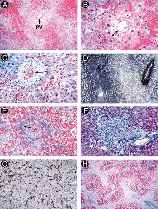 McDonald Figure 1. (in Wingard et al). Photomicrographs illustrating the evolution of histological abnormalities of sinusoidal obstructive syndrome (SOS). / A and B. Fatal SOS 23 days post-autograft (H&E). A, showing hemorrhage in zone 3 with sparing of zone 1 (PV, portal vein); B, high power section showing early changes of concentric venular luminal narrowing by a widened subendothelial zone (double arrow) containing entrapped red cells. The surrounding changes include necrotic hepatocytes, disrupted sinusoids, and hemorrhage into the space of Disse. / C. Severe SOS 21 days post-allograft (Gomori trichrome). Hepatocyte dropout, sinusoidal congestion, and embolization of a cluster of hepatocytes (arrow) into a partially collagenized venule. / D. Immunostained liver section of early SOS with anti-factor VIII/vWF, showing intense perivenular and adventitial staining, loss of the hepatocyte staining in zone 3, and preservation of portal and zone 1 anatomy. / E. Fatal SOS 31 days post-allograft (Mallory trichrome). A small sublobular venule nearly occluded by loose extracellular matrix and red cells within the widened subendotheial zone (double arrows). Extensive necrosis has obliterated the liver cords which are replaced by fine curvilinear strands of connective tissue admixed with red cells. / F and G. Fatal SOS 37 days after gemtuzamub ozogamicin infusion for relapsed AML post-transplant. F illustrates extensive zone 3 sinusoidal fibrosis adjacent to a non-occluded sublobular venule (Mallory trichrome). G is an immunostain of the same specimen with anti-alpha smooth muscle actin showing proliferation of activated hepatic stellate cells lining perivenular sinusoids. / H. Fatal SOS 67 days post-allograft (Mallory trichrome), showing a pattern of “reverse” cirrhosis with confluent bridging between collapsed, fibrotic perivenular zones containing venules occluded by fibrous matrix. / Reprinted with permission from Seminars in Liver Disease 2002;22:27–41.