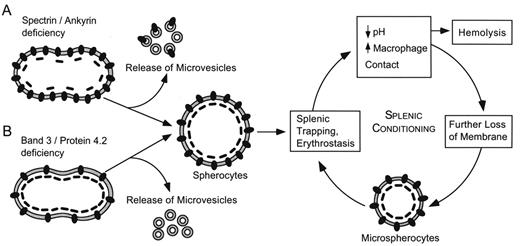 Figure 2. Pathophysiology of hereditary spherocytosis. The primary defect in hereditary spherocytosis is a deficiency of membrane surface area. Decreased surface area may produced by two different mechanisms: 1) Defects of spectrin, ankyrin, or protein 4.2 lead to reduced density of the membrane skeleton, destabilizing the overlying lipid bilayer and releasing band 3-containing microvesicles. 2) Defects of band 3 lead to band 3 deficiency and loss of its lipid-stabilizing effect. This results in the loss of band 3-free microvesicles. Both pathways result in membrane loss, decreased surface area, and formation of spherocytes with decreased deformability. These deformed erythrocytes become trapped in the hostile environment of the spleen where splenic conditioning inflicts further membrane damage, amplifying the cycle of membrane injury. / Reprinted with permission from Gallagher PG, Jarolim P: Red cell membrane disorders. In Hematology: Basic Principles and Practice. Hoffman R, Benz EJ Jr, Shattil SJ, et al (eds). 4th ed, WB Saunders, Philadelphia, 2005.