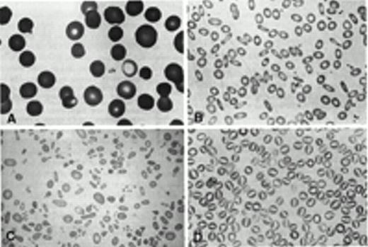Figure 3. Peripheral blood smears in disorders of the erythrocyte membrane. A. Hereditary spherocytosis. Characteristic spherocytes lacking central pallor are seen. B. Hereditary elliptocytosis. Smooth, cigar-shaped elliptocytes are seen. C. Hereditary pyropoikilocytosis. Pronounced microcytosis, poikilocytosis, fragmentation of erythrocytes and elliptocytes are seen. D. Hereditary stomatocytosis. Erythrocytes with slit-like, stomata are seen. Reprinted with permission from Gallagher PG. Disorders of erythrocyte metabolism and shape. In Hematologic Problems in the Neonate. Christensen RD (ed). WB Saunders, Philadelphia, 1999.