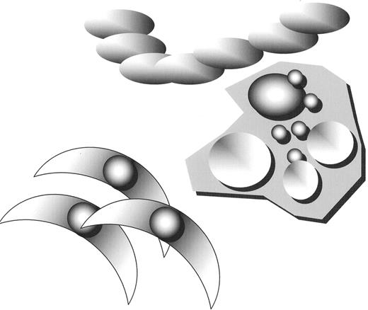 Figure 4. Clinically apparent disease if first noted as a result of the accumulation of foam cells.