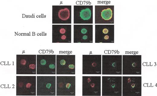 Dighiero Figure 1A. Defective assembly of Ig M and CD79b chains in chronic lymphocytic leukemia (CLL) patients. / Peripheral blood lymphocytes (PBLs) from four CLL patients, purified normal B cells or Daudi cells were fixed with PFA, permeabilized with saponin and co-labeled with anti-m Ab together with anti-CD79b Ab. The m chain was detected with a secondary Ab conjugated with Alexa 546 (red), the CD79b chain was detected with an Ab conjugated with FITC followed by an Ab conjugated with Alexa 488 (green). Yellow color at merged images indicates co-localization of the m and CD79b. It is shown that whereas m and CD79b co-localize in normal and Daudi B cells, co-localization is impaired in the case of CLL B cells.