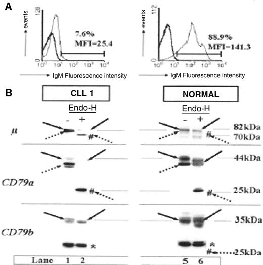 Figure 1C. Differences in IgM surface expression pro-files and B-cell receptor (BCR) component glycosylation status between chronic lymphocytic leukemia (CLL) patients and healthy subjects. / (A) Flow cytometry analysis of surface IgM staining. Results from a representative patient weakly expressing IgM, and from a representative healthy subject are shown. / (B) Glycosylation analysis of BCR components. Cell extracts (20 g) produced by lysis in modified bovine serum (MBS) were incubated at 37°C in the presence (+) or absence (−) of Endo-H and separated by 10% SDS-PAGE, and the resulting protein bands were transferred to nitrocellulose. Filters were probed with mAbs as follows: rabbit anti-m heavy chain, mouse anti-CD79a (CD79a), or anti-CD79b (CD79b), and immunoreactive bands were detected with an appropriate horseradish peroxidase–linked secondary antibody. Immature glycosylated (dotted arrows) and mature glycosylated (solid arrows) proteins are indicated for each staining. Forms deglycosylated by Endo-H treatment are indicated by #. Molecular masses are indicated in kilodaltons (kDa). The asterisk indicates a nonspecific band at 30 kDa constantly observed with the anti-CD79b probe from Pharmingen. It is shown that a majority of m and CD79a chains produced by CLL B cells are still sensitive to Endo-H, indicating that they are immature. / This contrasts with normal B cells where a majority of m and CD79a molecules are resistant to Endo-H. Interestingly, no defect in glycosylation could be found for CD79b molecules.