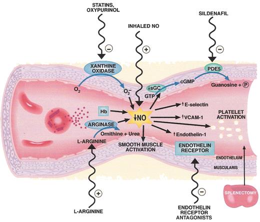 Gladwin and Kato Figure 1. Pathogenesis and therapeutic targets in hemolysis-associated pulmonary hypertension and vasculopathy. Intravascular hemolysis releases hemoglobin into plasma which reacts with and destroys endothelial derived nitric oxide (NO). Arginase is also released from the red cell into plasma during hemolysis and degrades arginine, further reducing NO formation from arginine. Xanthine oxidase bound to endothelium produces superoxide which also inhibits NO. Reduced NO bioavailability promotes vasoconstriction, activation of adhesion molecules (VCAM), activation of endothelin-1, a potent vasoconstrictor, and activation of platelets and thrombosis (tissue factor). Splenectomy is associated with pulmonary hypertension and may increase thrombotic risk as well as intravascular hemolysis. A number of therapies that target these pathways are shown on the outside of the blood vessel. . / Abbreviations: Hb, hemoglobin; PDE5, phosphodiesterase 5; VCAM-1, vascular cell adhesion molecule-1. / Figure reproduced with permission from Lin et al.63