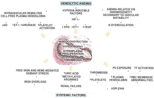 Gladwin and Kato Figure 2. Pathogenesis of pulmonary hypertension in patients with hemolytic disorders. . / The vessel shown in the figure is an autopsy specimen from a 55-year-old male with sickle cell disease and pulmonary hypertension and demonstrates the intimal and medial pulmonary arterial proliferative vasculopathy characteristic of the disease. Mechanistic factors related to hemolytic anemia and systemic complications of sickle cell disease that may contribute to the development of this vasculopathy are shown around the vessel. / Abbreviations: NO, nitric oxide; ET-1 endothelin 1; HIF, hypoxia inducible factor; EPO, erythropoietin; VEGF, vascular endothelial growth factor; PS, phosphatidylserine; TF, tissue factor; Q, lung perfusion. / Figure reproduced from Machado et al. with permission59
