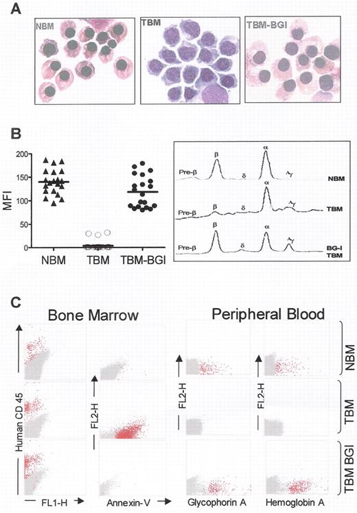 Malik and Arumagan Figure 1. Correction of β-thalassemia major in vitro and in vivo, in immune deficient mice. . / (A) Morphology of cultured CD34+ cells at day 10 of erythroid differentiation showing formation of hemoglobinized orthochromatic normoblasts in normal bone marrow (NBM). Normoblasts derived from thalassemia bone marrow CD34+ cells (TBM) fail to hemoglobinize and arrest at the polychromatophil normoblast stage of erythropoiesis, and undergo apoptosis thereafter. In contrast, normoblasts derived from TBM CD34+ cells transduced with the BGI vector (TBM-BGI) hemoglobinize and mature like those from NBM. (B) High level gene transfer and β-globin production in individual BFUe from thalassemia major bone marrow CD34+ cells transduced with the BGI vector. Individual BFUe were picked at 2 weeks and labeled with anti-HbA antibody and analyzed by FACS. The mean fluorescence intensity (MFI) of HbA expression from 20 individual BFUe colonies from NBM, TBM and TBM-BGI from one experiment is shown (left panel). Normal levels of β-globin production were seen in TBM-BGI erythroid liquid cultures, as shown by reverse phase HPLC analysis (right panel). (C) Reversal of ineffective erythropoiesis and expression of human β-globin in β2Mnull NOD-SCID mice. FACS analysis of β2Mnull NOD-SCID mouse bone marrow and blood was performed 12–16 weeks following transplant with NBM, TBM and TBM-BGI CD34+ cells. Representative dot-plots showing human CD45 (column 1) and Annexin-V staining (column 2), demonstrate sustained human cell engraftment in all mice, but presence of apoptotic cells only in TBM xenografts. Peripheral blood of the mice transplanted with NBM, TBM and TBM-BGI analyzed for glycophorin A (column 3) and HbA (column 4) expression shows presence of circulating human erythroid cells. All samples in columns 1–4 were gated on the basis of appropriate isotype controls and events falling within this gate are shown in dark gray. All events labeled with the respective human antibodies are shown in red. For intracellular HbA staining, human ζ-globin was used as the negative control and events falling within this gate are shown in dark gray. HbA labeled events falling outside this gate are shown in red.