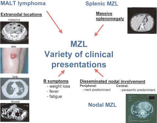 Thieblemont Figure 1. Variety of clinical presentations of marginal zone lymphoma (MZL).