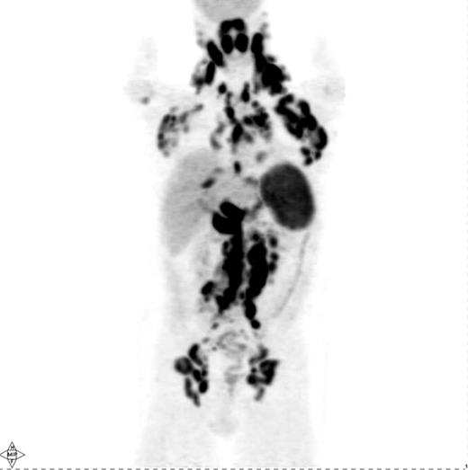 Figure 1. Pretreatment PET scan in a patient with Hodgkin lymphoma showing widespread cervical, axillary, mediastinal, hilar, abdominal and pelvic lymphadenopathy in addition to diffuse involvement of the spleen and focal liver involvement.