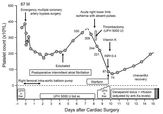 Figure 3A. A 67-year-old male developed acute right lower limb ischemia with absent pulses 8 days after emergency coronary artery bypass surgery. / The platelet count (309 × 109/L) had fallen only minimally (from 330 × 109/L) and the limb ischemia was attributed to either cardiac embolism (secondary to postoperative atrial fibrillation) or local right femoral injury (secondary to recent use of an intra-aortic balloon pump). After limb-salvaging thrombectomy (with intraoperative use of UFH), the patient received postoperative therapeutic-dose UFH monitored by the aPTT. Progressive decline in the platelet count by 78% to 74 × 109/L prompted the diagnosis of HIT, at which time the UFH was switched to danaparoid. Furthermore, vitamin K was given to reverse warfarin anticoagulation. Interestingly, a cool and painful left foot improved rapidly following treatment with vitamin K and danaparoid (not shown on the graph). / Abbreviations: bid, twice-daily; iv ther., intravenous therapeutic-dose; sc, subcutaneous; U, units; UFH, unfractionated heparin.