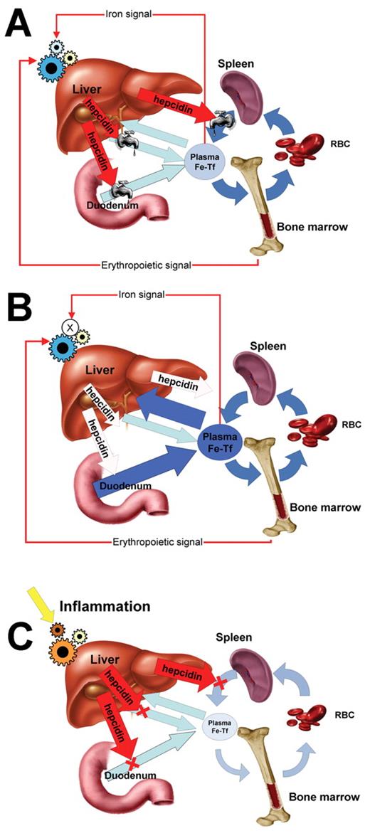 Ganz Figure 2. Regulation of systemic iron flows in normal subjects (A), patients with hereditary hemochromatosis (B) and patients with anemia of inflammation (C). / Iron flows are depicted by blue arrows and the effect of hepcidin by red arrows. Hepcidin-mediated regulation of iron efflux through ferroportin is depicted by valves that variably restrict iron flows. When hepcidin is deficient (B), iron absorption in the duodenum is increased, plasma transferrin becomes saturated with iron, and excess iron flows into the liver (large dark blue arrows). In anemia of inflammation (C), hepcidin synthesis is stimulated by inflammatory cytokines, and increased hepcidin (large red arrows) blocks major iron flows into plasma (light blue arrows). Plasma iron is decreased, limiting erythropoiesis.