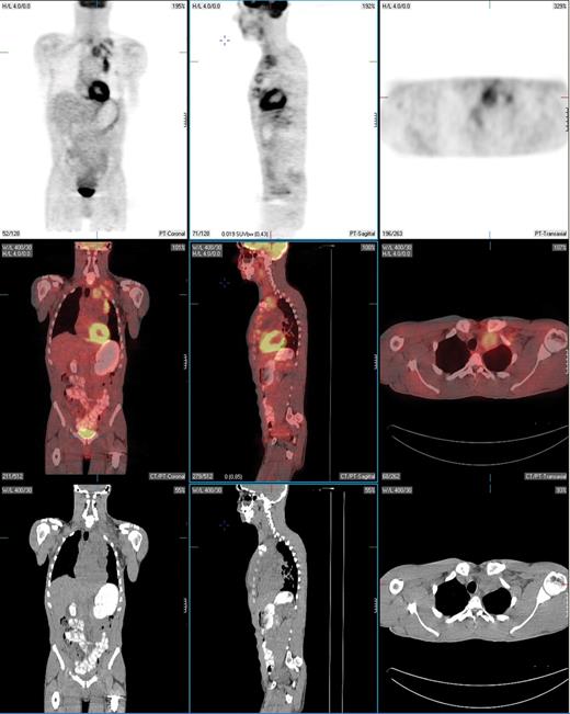 Juweid Figure 2. PET-positive residual mass in the anterior mediastinum extending into the left supraclavicular region in a patient with nodular sclerosis Hodgkin lymphoma. This patient underwent a restaging PET/CT scan 2 months following treatment with 6 cycles of ABVD. Fused PET/CT images show that the residual mass uptake is clearly greater than that of mediastinal blood pool structures, consistent with persistent disease. This was confirmed by fine needle aspiration and the patient then underwent salvage chemotherapy.