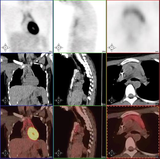 Juweid Figure 3. Post-treatment PET/CT scan in a 20-year-old patient with Hodgkin lymphoma showing thymic hyperplasia with otherwise no PET evidence of disease.
