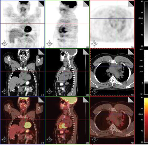 Juweid Figure 4. Post-treatment PET/CT scan performed 2 months after treatment with 8 cycles of AVD followed by involved field radiation therapy in a patient with stage IIA mixed cellularity Hodgkin lymphoma showing a PET-negative residual mass in the mediastinum measuring 4.2 × 2.9 cm. PET/CT was otherwise negative. This patient is currently without evidence of disease after 23 months of follow-up post therapy.