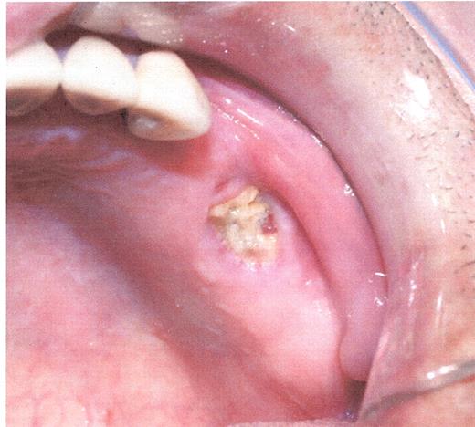 Mehrotra Figure 2a. Stage I osteonecrosis of the jaw (ONJ). Patient with myeloma on zoledronic acid for 18 months.
