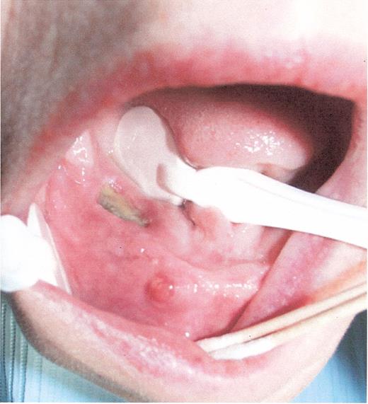 Mehrotra Figure 2b. Stage II osteonecrosis of the jaw (ONJ). Patient on zoledronic acid for 18 months.