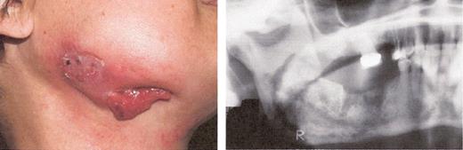 Mehrotra Figure 2c. Stage III osteonecrosis of the jaw (ONJ). Patient on pamidronate for 54 months followed by zoledronate for 18 months.
