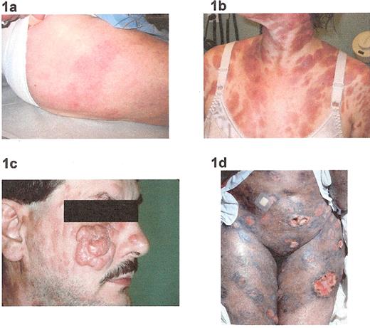 Rosen Figure 1. Clinical manifestations of mycosis fungoides: 1a) patches; 1b) plaques, 1c) tumors; 1d) ulcerations.