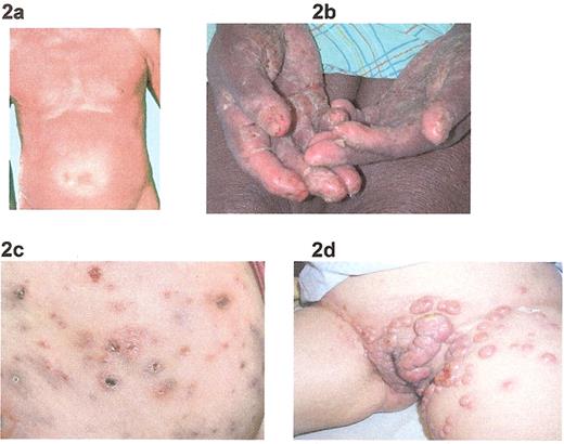 Rosen Figure 2. Clinical manifestations: 2a) Sézary syndrome; 2b) palmar keratoderma; 2c) lymphomatoid papulosis; 2d) anaplastic large T-cell lymphoma