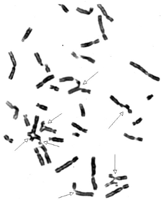 Figure 1. Fanconi anemia chromosomal breakage test. / Diepoxybutane-induced chromosomal breakage in a metaphase lymphocyte from a patient with Fanconi anemia. Chromosomes with breaks and fusions are indicated with arrows. Courtesy of Lisa Moreau, Dana Farber Cancer Institute, Boston, MA.
