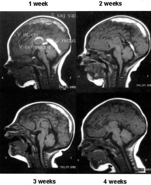 Figure 2. Thrombolytic therapy of an extensive sinus venous thrombosis in a newborn with heterozygous protein C deficiency by protein C concentrate after 1 week of ineffective UFH therapy (1 week) and, after initiating protein C replacement, at week 2, 3, and 4 of therapy, respectively. Note the almost complete re-canalization. / Abbreviations: UFH, unfrationated heparin; FAI, FM