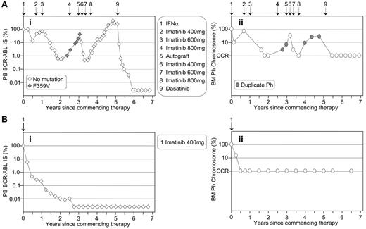 Figure 1. The pattern of molecular response is mirrored by the corresponding cytogenetic response. (A) The patient crossed over to imatinib after interferon-α failure and a rise in BCR-ABL (Ai) was associated with the detection of a consistently minor mutated clone. Corresponding bone marrow (BM) cytogenetic analysis (Aii) revealed loss of complete cytogenetic response (CCR) and a duplicate Ph. Interestingly, after an autologous transplantation the mutation was not detected. However, the duplicate Ph was present at loss of response, which possibly indicates that the minor mutated clone was eradicated at transplantation. This case illustrates the importance of cytogenetic analysis after loss of molecular response. (B) The patient had a typical rapid and sustained response to first-line imatinib. Molecular analysis (Bi) showed that BCR-ABL remained detectable for more than 2 years after CCR was documented at 6 months (Bii). This case illustrates that cytogenetic analysis may be of no clinical benefit while the patient maintains molecular response.