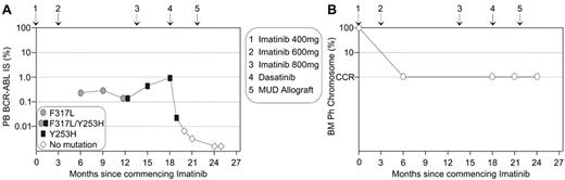 Figure 3. Molecular analysis and the characterization of imatinib-resistant mutations can aid timely therapeutic decisions. / (A) A 3-fold rise in BCR-ABL prompted mutation analysis. Imatinib failure was confirmed by the detection of the highly imatinib-resistant Y253H mutation, which became detectable after F317L. Y253H is one of the least sensitive mutations to nilotinib and F317L has been identified in dasatinib resistance screens. Dasatinib was commenced prior to matched unrelated donor (MUD) transplantation to maintain response. (B) The corresponding bone marrow (BM) cytogenetic analyses indicated maintenance of complete cytogenetic response (CCR), and these analyses did not contribute to early warning of imatinib failure that was evident by molecular analysis.