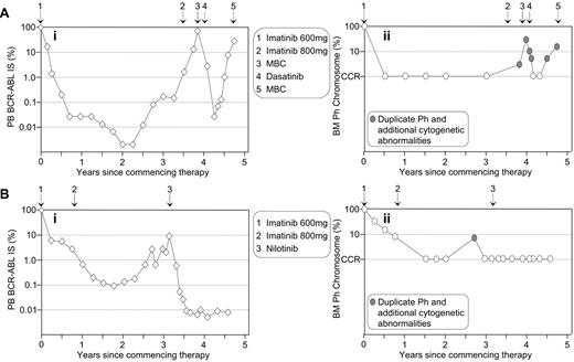 Figure 4. Molecular analysis as an aid to identify imatinib resistance unrelated to BCR-ABL mutations. Rising BCR-ABL levels of two patients (Ai and Bi) indicated potential imatinib resistance. No BCR-ABL mutations were detected. / Cytogenetic analysis indicated duplication of the Ph chromosome and the presence of additional cytogenetic abnormalities at loss of CCR for both patients (Aii and Bii). (A) The 57-year-old female was diagnosed in accelerated phase CML and commenced imatinib at 600 mg. An increased imatinib dose of 800 mg upon the rise in BCR-ABL failed to prevent progression to myeloid blast crisis (MBC). Dasatinib therapy reestablished CCR, but the patient relapsed. (B) The 42-year-old male commenced 600 mg imatinib upon diagnosis of chronic-phase CML. CCR was maintained after commencing nilotinib therapy.