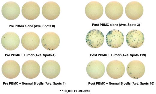 Neelapu and Kwak Figure 3. Tumor-specific cellular immune response induced following membrane proteoliposome vaccination in a representative patient with follicular lymphoma. Cryopreserved prevaccine and postvaccine peripheral blood mononuclear cells were cultured in either medium alone, or with soluble CD40 ligand–activated autologous tumor cells or soluble CD40 ligand–activated autologous normal B cells and cytokine production was detected by IFN-γ enzyme-linked immunopsot (ELISPOT) assay. Representative wells of ELISPOT demonstrating IFN-γ spots are shown. Significantly increased number of IFN-γ spots were detected in response to autologous tumor cells but not in response to autologous normal B cells by the postvaccine T cells.