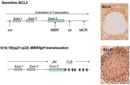 Natkunam Figure 2. The t(14;18) translocation and expression of the BCL2 protein. Schematic representations show the germline configuration of the BCL2 gene as well as the chromosomal breakpoints involved in the t(14;18)(q21;q32) translocation. The BCL2 protein is absent in normal germinal center B-cells whereas it is expressed in the neoplastic follicles of follicular lymphoma, as shown by immunohistologic staining for the BCL2 protein.