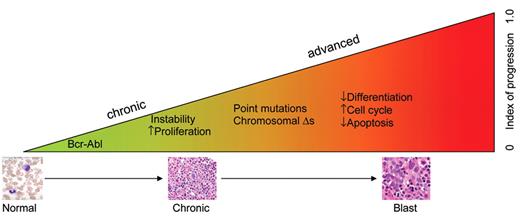Radich Figure 2A. CML progression. Stem cells acquire the Philadelphia chromosome. This begins a process of instability, and increased proliferation yielding multiple clones of progenitors. With unchecked Bcr-Abl activity, instability causes genetic alterations, including point mutations in Abl (and elsewhere), and gross cytogenetic changes. This causes a block in differentiation, increased proliferation of primitive cells, and a block of apoptosis. In this model, progression from chronic to blast phase begins from the outset of disease. The ability of TKI to arrest the progression depends on how long Bcr-Abl activity went on unimpeded.