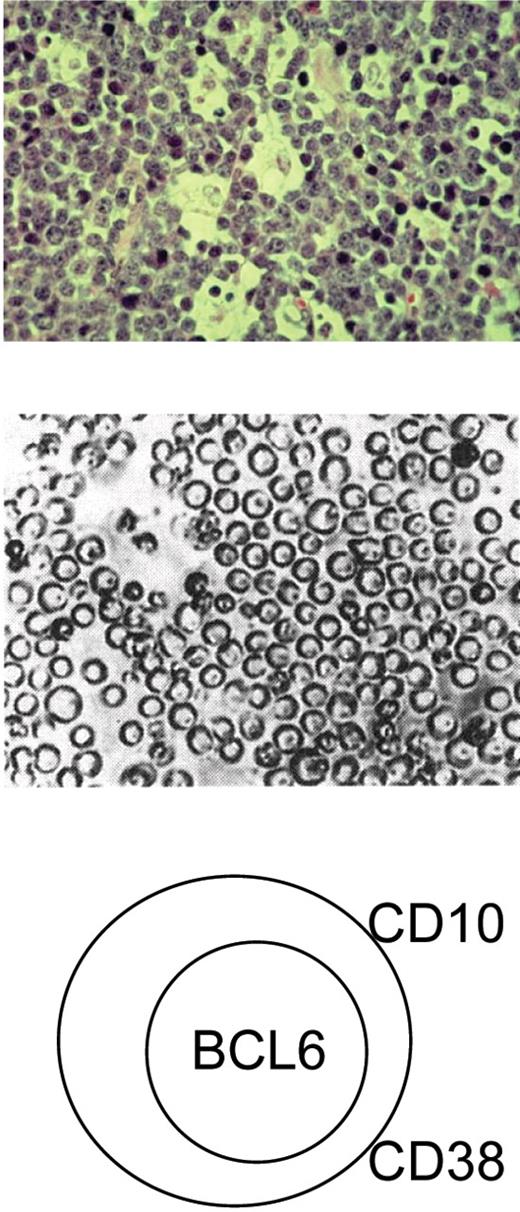 Kelly and Rickinson Figure 1. Characteristic features of Burkitt lymphoma (BL) cells. Top: characteristic ‘starry sky’ histology associated with BL tumors brought about by the presence of round monomorphic B cells interspersed with macrophages. Middle: BL cells grow as round single cells in culture. Bottom: BL cells express markers characteristic of germinal center B cells such as CD10, CD38 and BCL6.