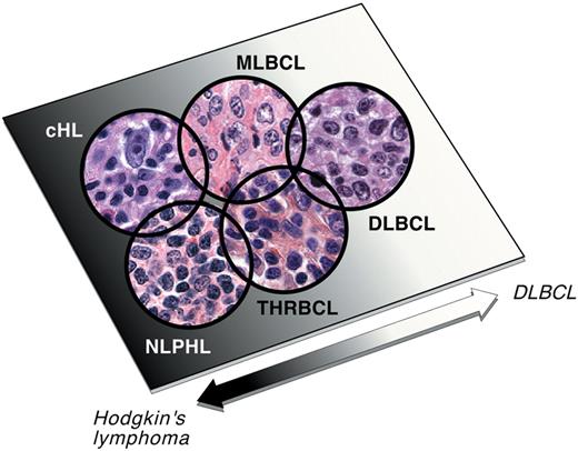 Shipp Figure 3. DLBCL, gray zone lymphomas, and Hodgkin lymphomas. MLBCL and T-cell/histocyte-rich large B-cell lymphoma (T/HRBCL) are considered “gray zone lymphomas,” which share certain characteristics of large B-cell lymphomas and Hodgkin lymphomas (cHL and NLPHL, respectively), including increased host inflammatory response. The similarities among these entities point to a group of tumors that are partially defined and possibly driven by their interaction with the host microenvironment. Reprinted with permission from Abramson and Shipp.2