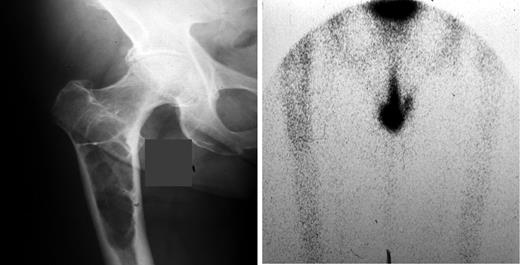 Figure 1. Bone scans can underestimate the degree of bone involvement in myeloma because bone disease in myeloma is characterized by bone destruction with absent new bone formation. This patient has a large lytic lesion on plain radiographs and a negative bone scan. Courtesy of Dr. Mankin, Massachusetts General Hospital.