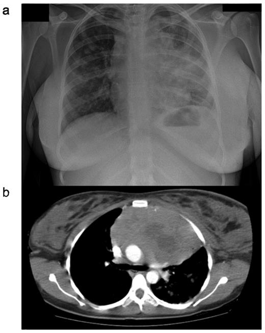 Figure 1. CXR (a) and CT (b) scan from a female patient presenting with primary mediastinal large B-cell lymphoma (PMBL). Note is the large anterior mediastinal mass, with areas suggestive of central necrosis. Marked breast edema is present.
