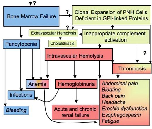 Bessler and Hiken (pp 104–110) Figure 1. The pathophysiology of disease in patients with paroxysmal nocturnal hemoglobinuria (PNH). Bone marrow failure and the occurrence of PNH blood cells are the two major components in the pathophysiology of PNH and explain the major clinical symptoms of patients with this disease, which are pancytopenia, hemolysis and thrombosis (see also text). The demonstration of blood cells deficient in GPI-linked proteins is sufficient for the diagnosis of the disease. Immune suppressive treatment improves bone marrow failure but does not influence the existence of PNH cells, whereas inhibition of intravascular hemolysis improves hemolysis-associated symptoms, but has no effect on bone marrow failure or on extravascular hemolysis. The increased understanding of the pathophysiology has greatly improved diagnosis and treatment of patients with this disease. However, a few critical “?” remain that need to be solved in order to fully cure the disease.