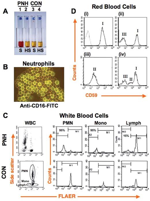 Bessler and Hiken (pp 104–110) Figure 3. Diagnosis of paroxysmal nocturnal hemoglobinuria (PNH). (A) Ham test, the traditional clinical assay for diagnosis of PNH, is based on the increased susceptibility of PNH red blood cells to complement-mediated lysis. PNH (tubes 1, 2) and control (tubes 3, 4) red blood cells are incubated with serum (S), or serum in which complement has been heat inactivated (HS). Cells and debris are pelleted, and the degree of lysis is assessed by the presence of red pigment from hemoglobin in the serum. Only PNH red blood cells show complement-dependent lysis (tube 1), due to their lack of expression of GPI-linked complement inhibitors CD55 and CD59, while control red blood cells are protected (tube 3). (B) Granulocytes from a PNH patient were stained with fluorescently labeled antibody against the GPI-linked protein CD16. Strongly positive (normal) and completely negative (PNH) cells are present. Typically, populations of both normal and PNH hematopoietic cells reside simultaneously in the peripheral blood. (C) Diagnosis of PNH by using flow cytometry. All hematopoietic lineages can be affected by PNH. Currently, clinical assays often assess PNH based on staining of white blood cells with fluorescently labeled antibodies against at least two GPI-linked proteins or, as shown here using FLAER, a fluorescently labeled derivative of the bacterial protein aerolysin, which naturally binds the GPI anchor. On the left the dot plot analysis of total peripheral blood white blood cells (WBC) from PNH (top) and control (bottom) individuals are shown. Note that in the sample from the PNH patient a proportion of cells have a decreased binding of FLAER (PNH cells). To the right the histograms of specific white blood cell lineages seen in the associated dot plots show substantially reduced FLAER binding to PNH (top) on 95% of neutrophils (PMN) and monocytes (Mono), 15% of lymphocytes (Lymph), as compared to control (bottom). (D) FACS analysis of red blood cells using fluorescently labeled anti-CD59 is used to assess the PNH red cell population and the degree of GPI-anchor deficiency. Normal individuals show uniformly strong staining of red blood cells with CD59 ((i), hatched line shows isotype-matched control antibody). A classic PNH patient (ii) shows distinct populations of type III cells, which are completely deficient in surface expression of GPI-linked proteins, and type I cells, which show normal expression of GPI-linked proteins. Type II cells show a partial deficiency of GPI-linked protein surface expression and can be seen in PNH patients either alone (iii) or in combination with type III and/or type I populations (iv).
