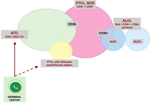 de Leval and Gaulard (pp 272–279) Figure 3. The overlapping spectrum of nodal peripheral T-cell lymphomas (PTCL) entities. / Nodal PTCLs comprise four main entities: angioimmunoblastic T-cell lymphoma (AITL), ALK+anaplastic large cell lymphoma (ALCL), ALK– ALCL and PTCL, not otherwise specified (PTCL, NOS). The only well-demarcated entity is ALK+ ALCL. TFH cells have recently been identified as the cell of origin of AITL, whereas the cellular origin of the other entities is not known precisely. There is a lack of specific definition criteria for PTCL, NOS, and thus substantial overlap with AITL, and ALK– ALCL. Gene expression profiling analyses have identified traces of the TFH signature in a subset of PTCL, NOS, suggesting that the spectrum of AITL may be wider than anticipated. A small group of “follicular” PTCLs, different from AITL, might also derive from TFH cells and could be associated with a distinct translocation t(5 ;9) involving ITK and SYK. The overlap between PTCL, NOS and ALK– ALCL is accounted by a subset of PTCLs composed of large CD30+ cells.