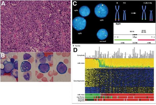 Perkins and Friedberg (pp 341–348) Figure 2. A. Low-power H&E-stained section of a lymph node involved with Burkitt lymphoma (BL) from an 82-year-old man. Note the uniform appearance of the cells, the diffuse pattern of growth, and the nuclear debris from apoptotic cells, mostly contained within the cytoplasm of pale-staining tingible-body macrophages. B. Cytology of bone marrow cells, as seen on Wright-Giemsa–stained aspirates and touch preps. Note the high nuclear-to-cytoplasmic ratio, moderately abundant dark blue cytoplasm with occasional vacuoles, and nucleus with finely granular chromatin and multiple nucleoli. C. Identification of MYC translocation by FISH analysis using “MYC break-apart probes. When together, as in a normal chromosome, the two probes are located in close proximity and give a composite yellow color, while the probes are distinct when translocation occurs (Taken with permission from Hecht and Aster39). D. Composite figure from paper by Hummel et al.6 depicting the results of gene array studies, karyotype and FISH analyses. Top, bar graph depicting the karyotypic complexity of each case. The mBL Index section depicts a heat map of the 58 mBL signature genes; blue is low expression, while yellow is high expression. IG-myc translocations are in bright green; non-IG-myc fusions are in dark green, and myc-absent are in red. At bottom, histologic diagnosis: bright green, BL; dark green, atypical BL; red, diffuse large B-cell lymphoma (DLBCL); grey, unclassifiable mature aggressive B-cell lymphoma.
