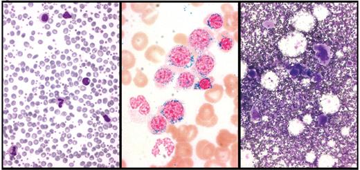 Hellström-Lindberg and Cazzola (pp 52–59) Figure 1. Peripheral blood and bone marrow smears from a patient with refractory anemia with ringed sideroblasts and thrombocytosis (RARS-T). Left panel: peripheral blood smear showing abundant platelets. Middle panel: Perls staining of bone marrow smear showing numerous ringed sideroblasts. Right panel: May Grünwald-Giemsa staining of bone marrow smear showing abnormal megakaryocytes. Courtesy of Rosangela Invernizzi.