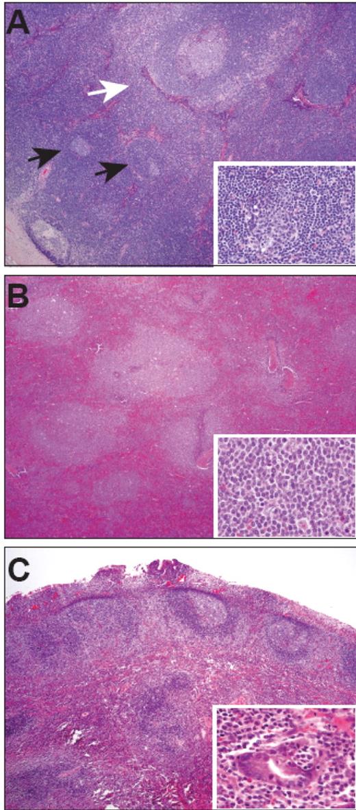 Kahl and Yang (pp 359–364) Figure 1. Histologic examples of nodal marginal zone lymphoma (NMZL), splenic marginal zone lymphoma (SMZL), and gastric extranodal marginal zone lymphoma (gastric MALT lymphoma). A. Whole mount of a lymph node with NMZL. A thickened capsule (lower left) and interfollicular infiltrate of small B lymphocytes and monocytoid B cells is shown. A reactive follicle (white arrow) is surrounded by an expanded marginal zone of monocytoid B cells while other follicles have been partially replaced by small B cells (black arrows and inset). B. Section of a spleen with SMZL showing marked expansion of the white pulp by monocytoid B cells (inset). Note the lack of follicular mantles and infiltration of monocytoid B cells into the splenic red pulp. C. Full thickness section of gastric MALT lymphoma showing an ulcerated epithelial surface and diffuse infiltrate of marginal zone cells in the lamina propria that have colonized the germinal centers of the B-cell follicles. Scattered lymphoepithelial lesions were also present (inset).