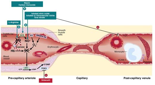 Kato (pp 186–192) Figure 1. Vascular based therapeutic targets in sickle cell disease (SCD). Several mechanisms have been proposed to contribute to pathological blood flow in SCD: intravascular hemolysis, which releases arginase and hemoglobin (Hb), which respectively reduce levels of the nitric oxide synthase (NOS) substrate arginine and consumes NO; oxygen radicals produced by xanthine oxidoreductase (XO) and NADPH oxidase; sickle hemoglobin polymer formation, inducing stiff, noncompliant red cells; and adhesion of sickle erythrocytes, leukocytes, and platelets to post-capillary venular endothelium. Strategies being tested in clinical trials directed at these pathways are indicated in the boxes and described in detail in the text.