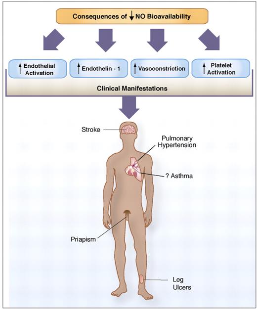 Morris (pp 177–185) Figure 2. Consequences of low nitric oxide (NO) bioavailability. The consequences of decreased NO bioavailability include endothelial cell activation, upregulation of the potent vasoconstrictor endothelin-1, vasoconstriction, platelet activation, increased tissue factor and activation of coagulation pathways, all of which ultimately translates into the clinical manifestations of sickle cell disease. NO bioavailability is particularly vulnerable to the effects of hemolysis, an event in sickle cell disease that contributes to the development of the hemolytic subphenotypes, which include pulmonary hypertension, priapism, cutaneous leg ulceration, stroke and possibly asthma.