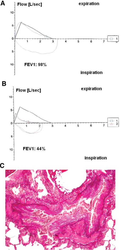 Tichelli et al (pp 125–133) Figure 2. Pulmonary function tests and histology of a patient with bronchiolitis obliterans after hematopoietic stem cell transplantation (HSCT). Flow-volume loop of a forced vital capacity maneuver. Positive values represent expiration, negative values represent inspiration. The trace moves clockwise for expiration followed by inspiration. A: normal pulmonary function at one year after HSCT. B: abnormal pulmonary function one year later, with expiration prolongation, decreased forced expiratory volume at one second (FEV1, 44% of the predicted value). C: histology of bronchiolitis obliterans showing dense concentric peribronchial fibrosis with luminal obliteration, but a relative paucity of inflammatory cells. Note the relative sparing of the alveolar spaces (with the courtesy of Prof. Stephan Dirnhofer, University Hospital, Basel, Switzerland)