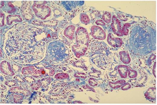 Tichelli et al (pp 125–133) Figure 4. Renal histology showing cyclosporine toxicity. Vacuolation of the proximal tubular epithelium (*), beaded medial hyalinosis in afferent arteriolae (^), three glomerula with global sclerosis and one glomerulum with compensatory hypertrophy (with the courtesy of Prof. Stephan Dirnhofer, University Hospital, Basel, Switzerland).