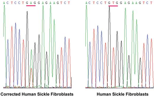 Townes (pp 193–196) Figure 2. Correction of a βS gene in skin fibroblasts from a sickle cell patient.
