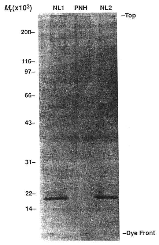 Figure 4. Demonstration that paroxysmal nocturnal hemoglobinuria (PNH) erythrocytes are deficient in MIRL (CD59), the glycosyl phosphatidylinositol (GPI)–anchored protein that inhibits formation of the membrane attack complex of complement. Illustrated is analysis by western blot of normal (NL) and PNH erythrocyte membrane proteins using anti-MIRL as the primary antibody. A band representing a protein with a molecular mass of ~18 kilodaltons is present in the lanes containing normal erythrocyte membrane proteins (NL1 and NL2). A band with this mass is absent in the lane containing the PNH erythrocytes membrane proteins (PNH). Deficiency of MIRL (CD59) and DAF (CD55) accounts for the abnormal sensitivity of PNH erythrocytes to complement-mediated lysis.
Reproduced from Holguin MH, Fredrick LR, Bernshaw NJ, Wilcox LA, Parker CJ. Isolation and characterization of a membrane protein from normal human erythrocytes that inhibits reactive lysis of the erythrocytes of paroxysmal nocturnal hemoglobinuria. J Clin Invest. 1989;84:7–17 by copyright permission of The American Society of Clinical Investigation.