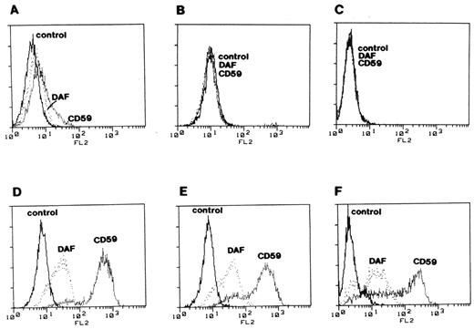 Figure 6. Complementation of deficient surface expression of DAF and MIRL (CD59) on paroxysmal nocturnal hemoglobinuria (PNH) cells. Three glycosyl phosphatidylinositol (GPI)–anchor-deficient cell lines derived from B lymphocytes of patients with PNH (panels A, B & C) were stained with anti-DAF and anti-MIRL (CD59) and analyzed by flow cytometry. The same cell lines transfected with PIGA cDNA (panels D, E & F) were analyzed under the same conditions as the controls. These experiments implied that PIGA is the gene that is mutant in PNH. That mutations in PIGA account for the deficiency of GPI-anchored proteins in PNH was demonstrated by Dr. Junji Takeda, Dr. Taroh Kinoshita and colleagues in this same landmark paper.
Reproduced from Takeda J, Miyata T, Kawagoe K, et al. Deficiency of the GPI anchor caused by a somatic mutation of the PIGA gene in paroxysmal nocturnal hemoglobinuria. Cell. 1993;73:703–711 by copyright permission from Elsevier Science.